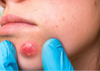 Boils: Home remedies to get rid of this condition in no time