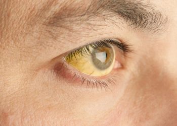 Yellow fever: More 70  people feared dead in Enugu