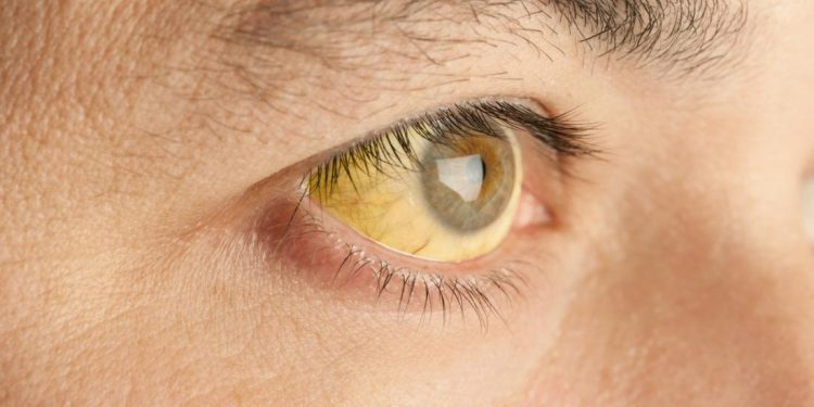 Yellow fever: More 70 people feared dead in Enugu