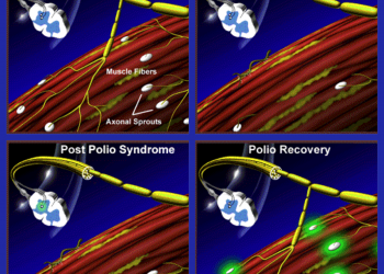 GIWP launches post- polio syndrome awareness campaign