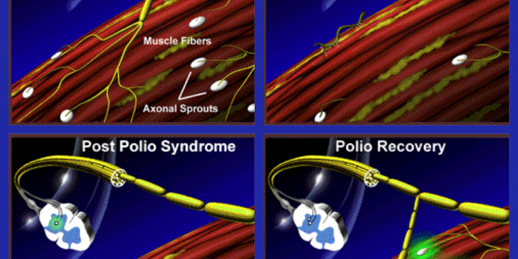 GIWP launches post- polio syndrome awareness campaign