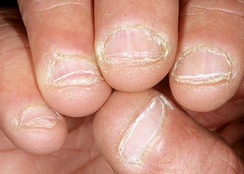 Causes and treatment of fingernails falling off