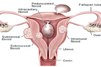 Fibroids can cause infertility but  there is solution