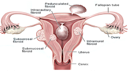 Fibroids can cause infertility but there is solution