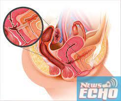 Vesico-vaginal fistula: CMD, NOFIC worry over rising suffering of women