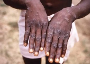Monkeypox: Another killer disease hits Nigeria; records 558 cases, eight deaths in five years