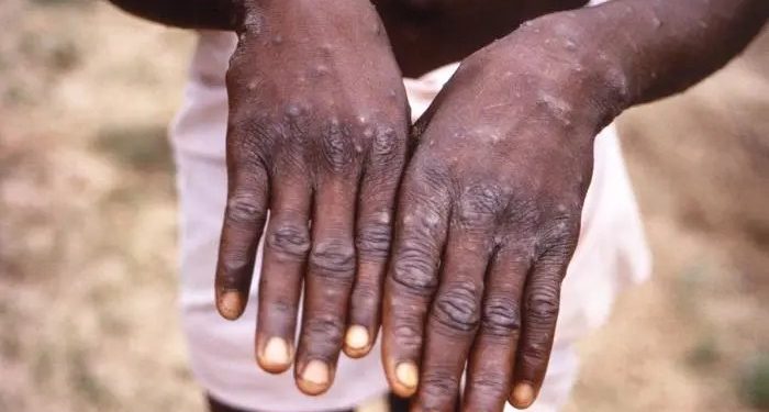 Monkeypox: Another killer disease hits Nigeria; records 558 cases, eight deaths in five years