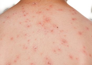 WHO says Monkeypox not yet global health emergency