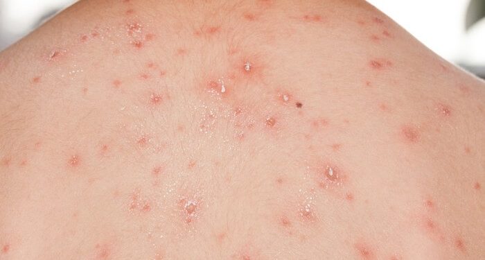 WHO says Monkeypox not yet global health emergency