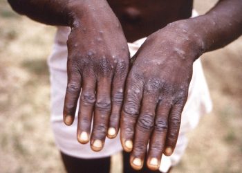 Contending Monkeypox as WHO Declares disease Global Emergency