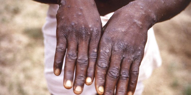 Contending Monkeypox as WHO Declares disease Global Emergency