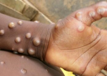 Monkeypox – how does it spread and what are the symptoms? (VIDEO)