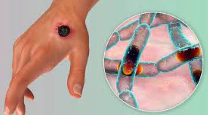 Moving against outbreak, spread of Anthrax