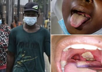 Diphtheria infections: Enugu, Imo record I each as nation hits over 9,000 cases