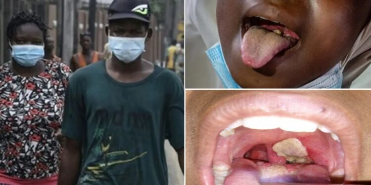 Diphtheria infections: Enugu, Imo record I each as nation hits over 9,000 cases